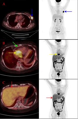 Cardiac involvement in a patient with B-cell lymphoblastic lymphoma/acute lymphoblastic leukemia and a history of allogeneic hematopoietic stem cell transplantation and CAR T-cell therapy: A case report